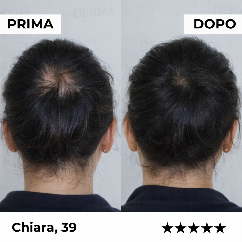 Sistema di microinfusione Firmelià® per la ricrescita dei capelli nelle donne