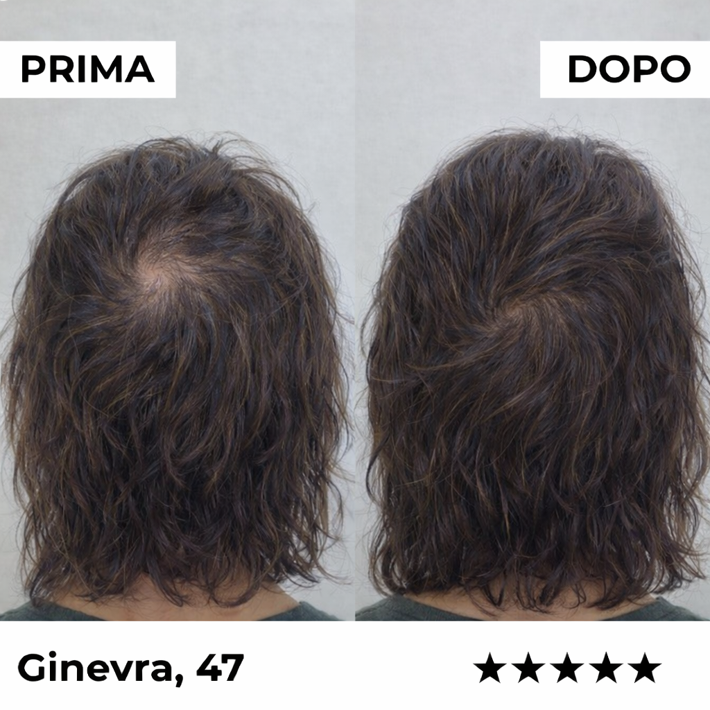 Sistema di microinfusione Firmelià® per la ricrescita dei capelli nelle donne