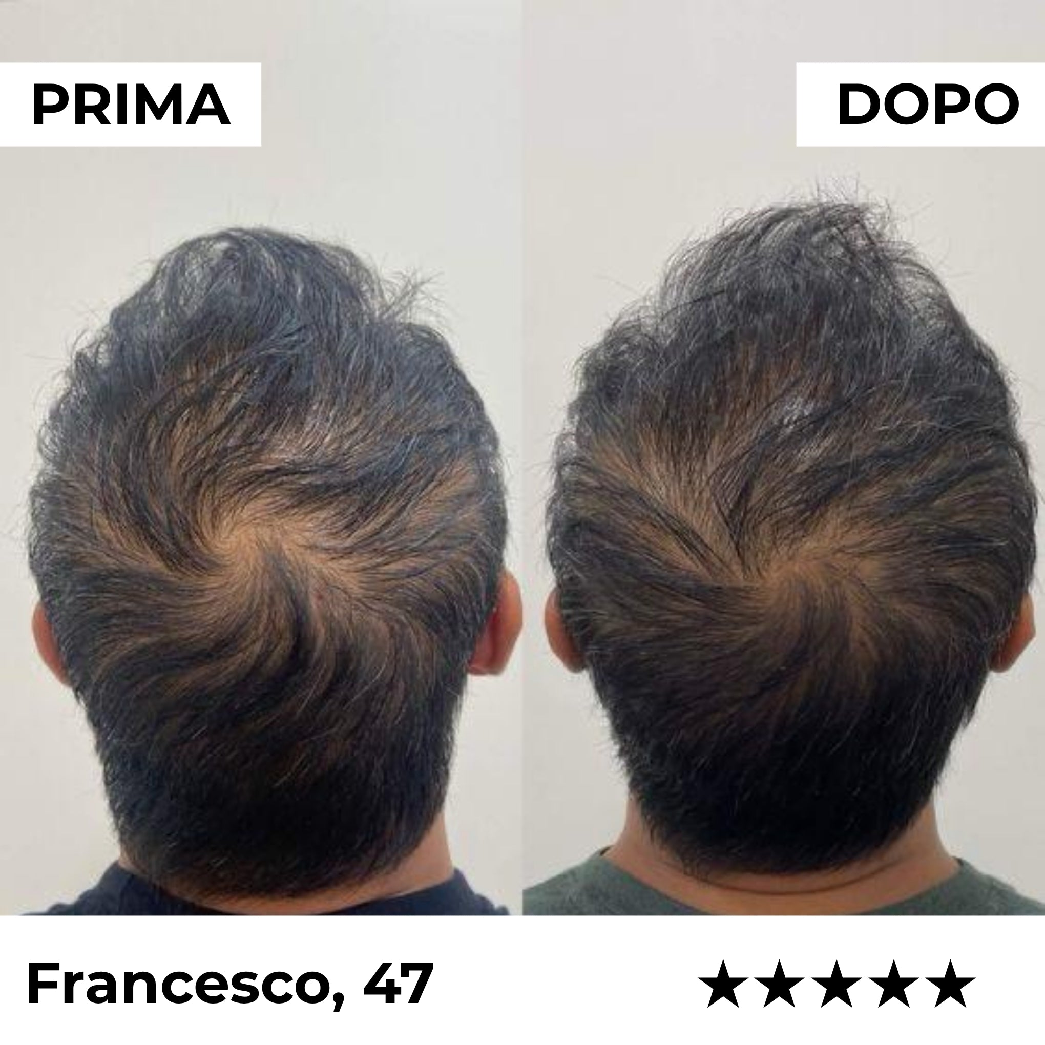 Firmelià® Sistema di Micro-Infusione per Ricrescita Capelli