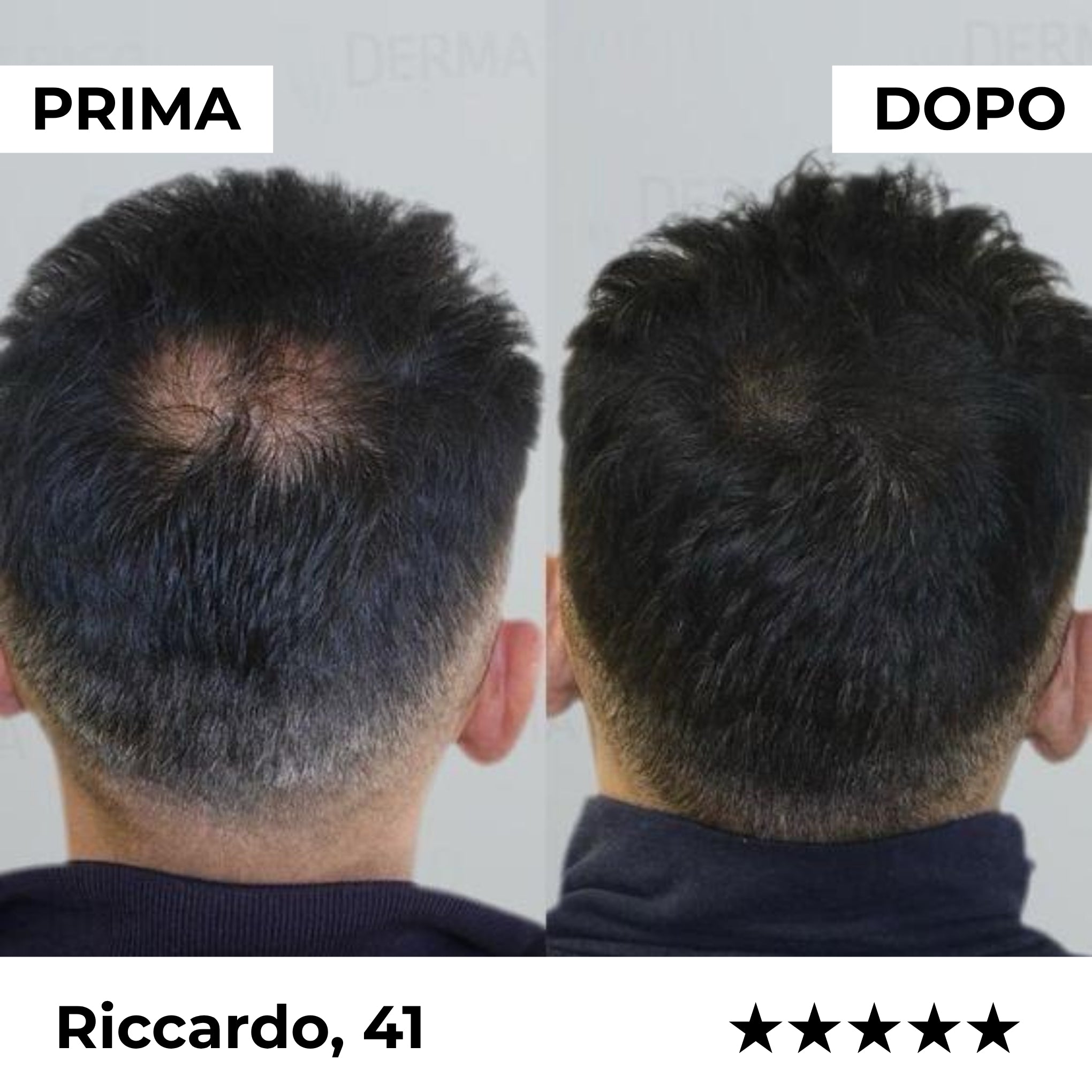 Firmelià® Sistema di Micro-Infusione per Ricrescita Capelli